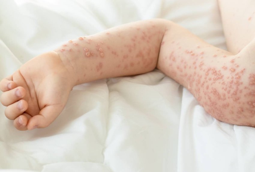 Prevencia voči ovčím kiahňam
