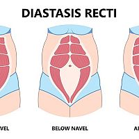 Diastáza typy