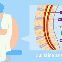Spinálna anestézia pri cisárskom reze